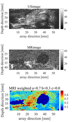 頸部の超音波像（上段）とMRI（中段）と融合画像（下段） 